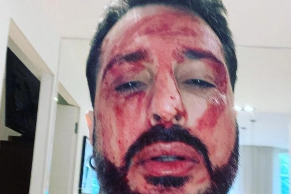 Fabrizio Corona col volto sporco di sangue