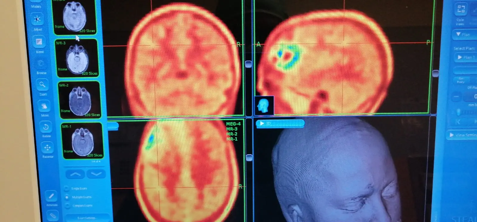 Scoperto un vaccino che allunga la vita ai malati di tumore aggressivo al cervello