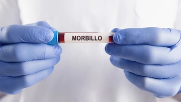 Morbillo, allarme in Europa. L’esperta: perché è tornato e quali conseguenze può provocare