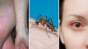 Febbre Dengue: come si trasmette e quali sono i sintomi della malattia. Consigli per la disinfestazione
