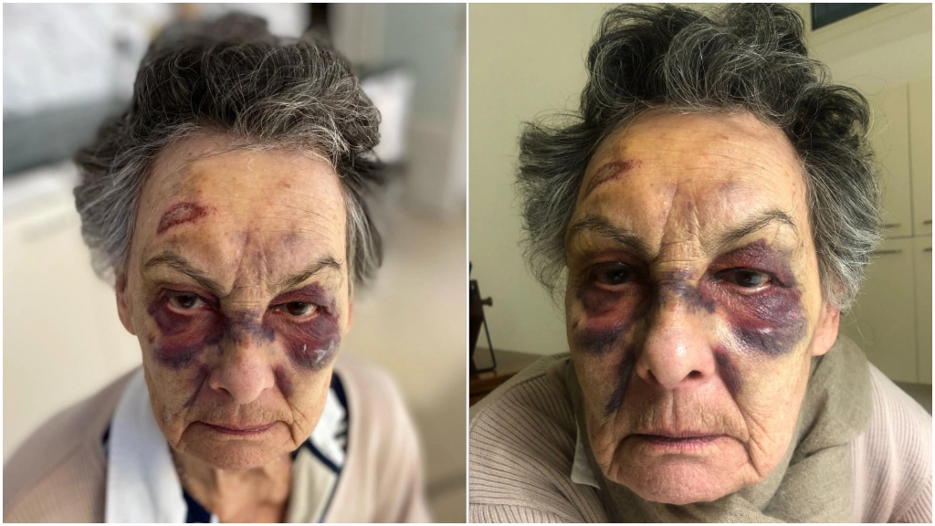Le ferite sul volto dell'anziana aggredita in centro a Milano