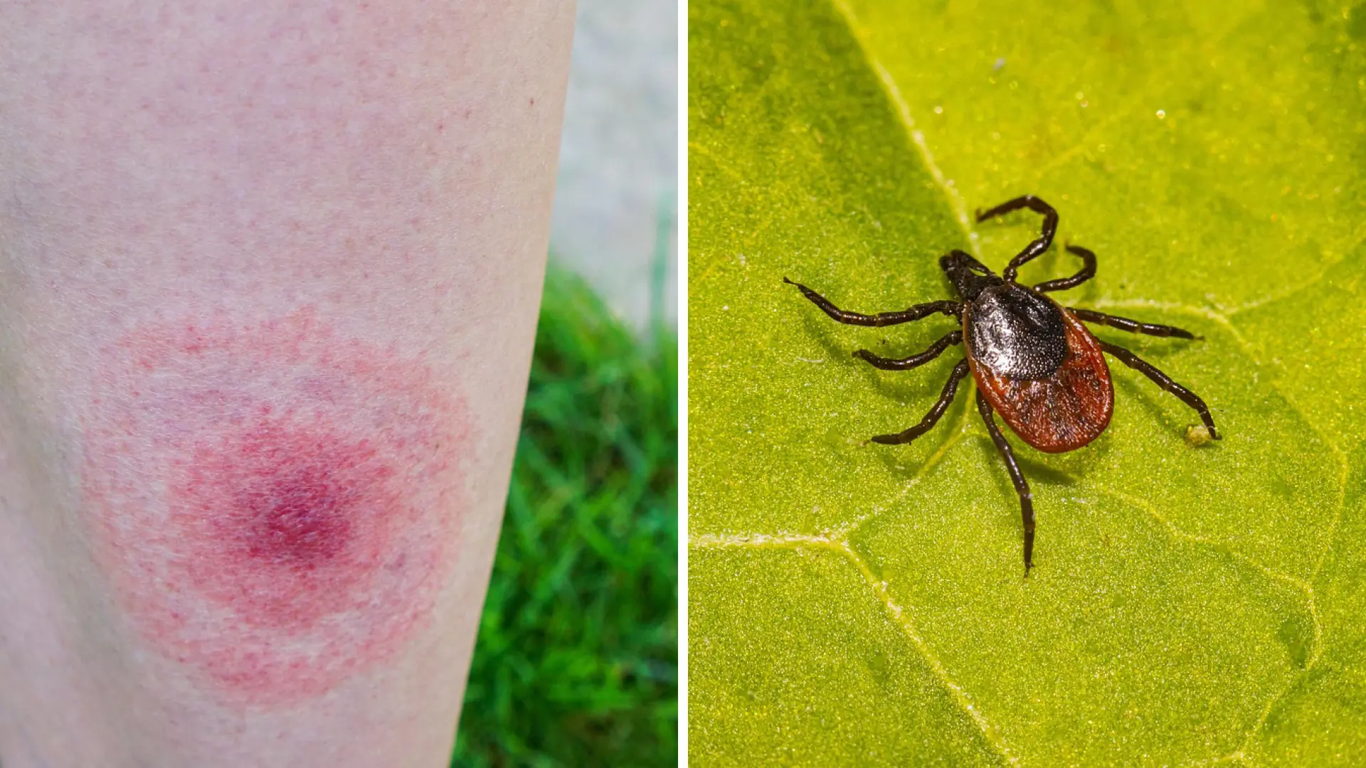 Cos’è la malattia di Lyme trasmessa dalle zecche: sintomi, diagnosi, cura e mortalità